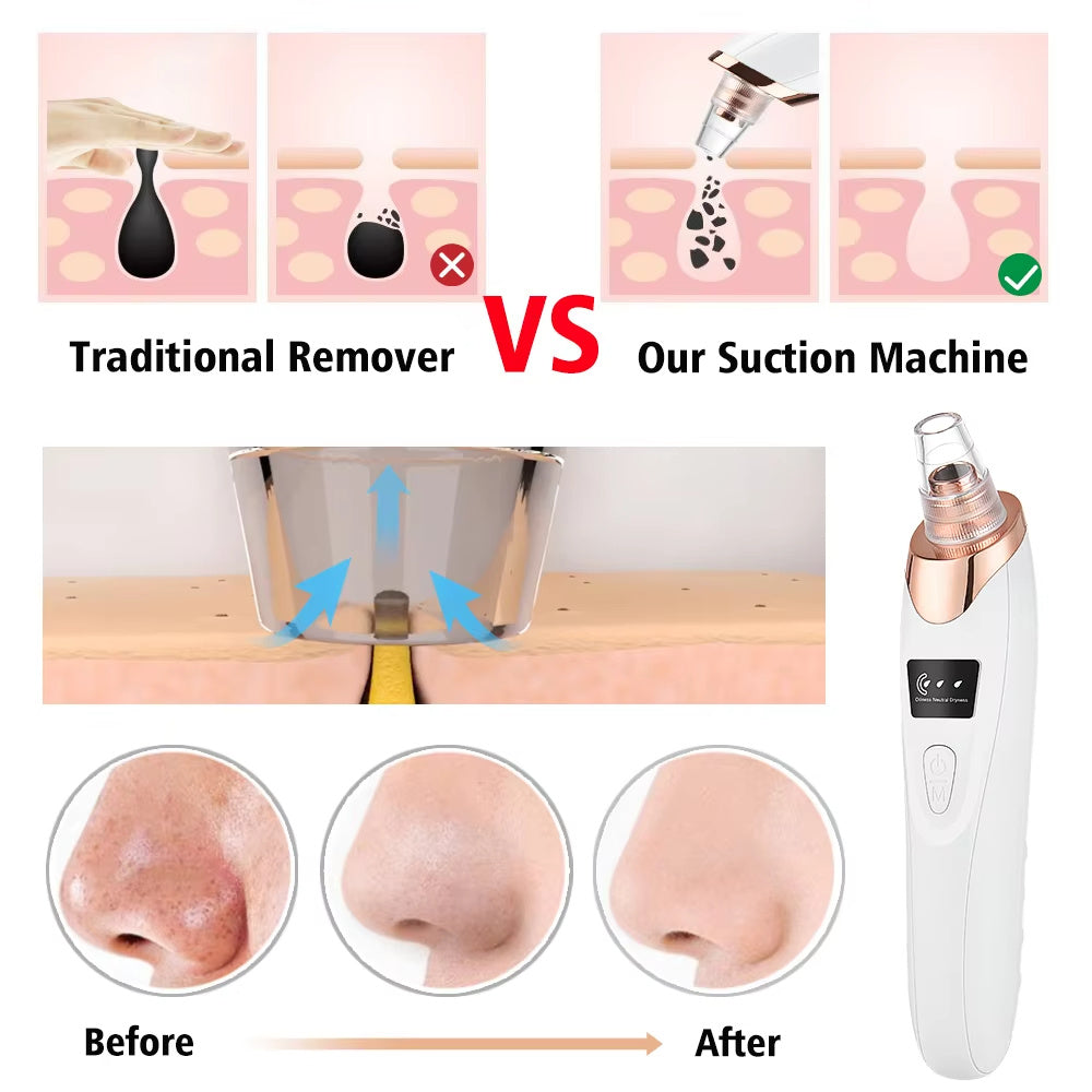 Electric Blackhead Remover Vacuum – Pore Cleaner with 5 Suction Heads & USB Rechargeable Facial Tool for Women’s Skincare
