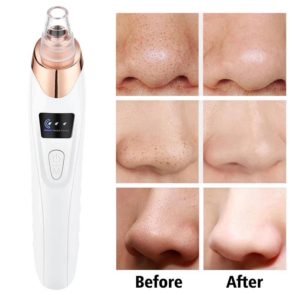 Electric Blackhead Remover Vacuum – Pore Cleaner with 5 Suction Heads & USB Rechargeable Facial Tool for Women’s Skincare